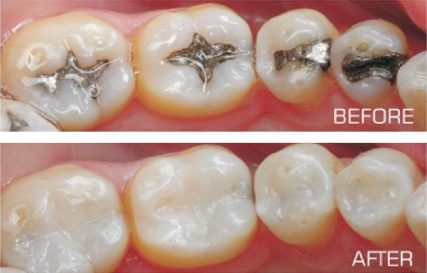 Tooth Coloured fillings 1